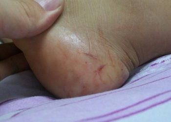 2-yr-old boy dies from snake bite after being denied medical treatment