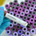 Fake COVID-19 Test: NOGUCHI won't accept results from unapproved test kits
