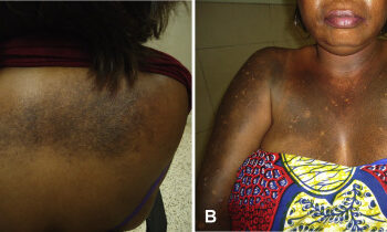 What bleaching can do to the body