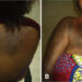 What bleaching can do to the body