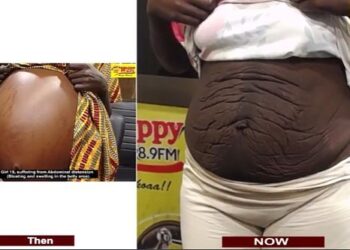 Girl suffering from abdominal distention narrates how NsemPii team helped her recover