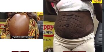 Girl suffering from abdominal distention narrates how NsemPii team helped her recover