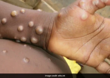 Ghana Health Service confirms monkeypox case in Western North Region