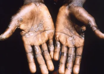 Ghana Health Service confirms Monkeypox cases in  Ghana