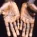 Ghana Health Service confirms Monkeypox cases in  Ghana