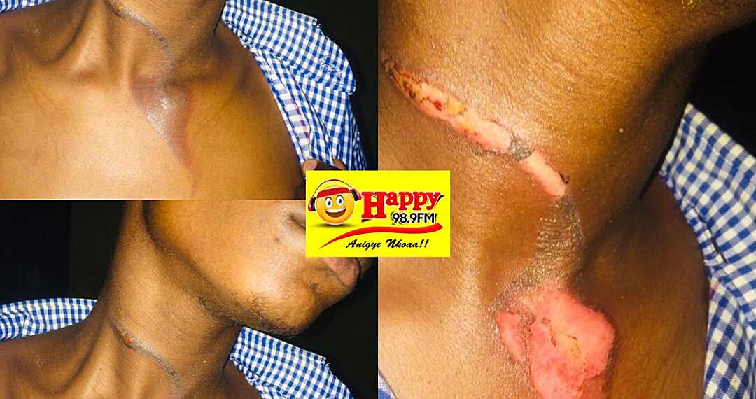 High School Brutalities: Student of Adaklu SHS burnt with hot pressing iron by colleague