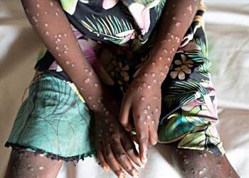 Mpox cases climb to 170: Health Officials urge vigilance