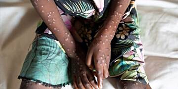 Mpox cases climb to 170: Health Officials urge vigilance