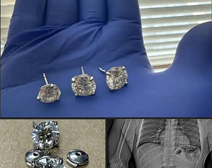 Florida police recover $769,500 worth of earrings after suspect allegedly swallows them