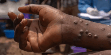 Sunyani East records two Mpox cases: health director issues urgent call to action