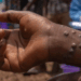 Sunyani East records two Mpox cases: health director issues urgent call to action