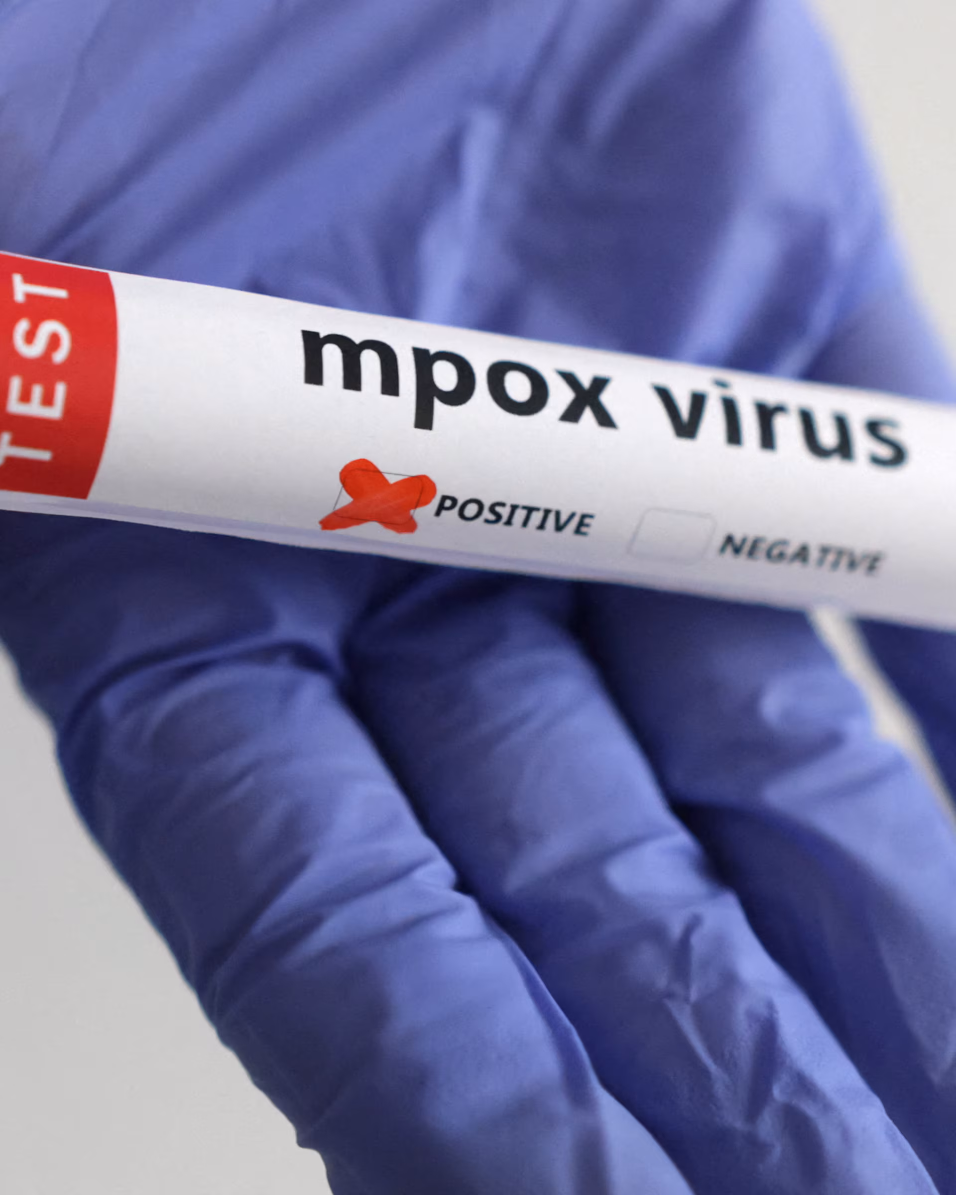 Mpox hits Namibia; first case confirmed