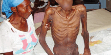 HIV has claimed 44 Million lives globally - WHO warns virus remains major health threat